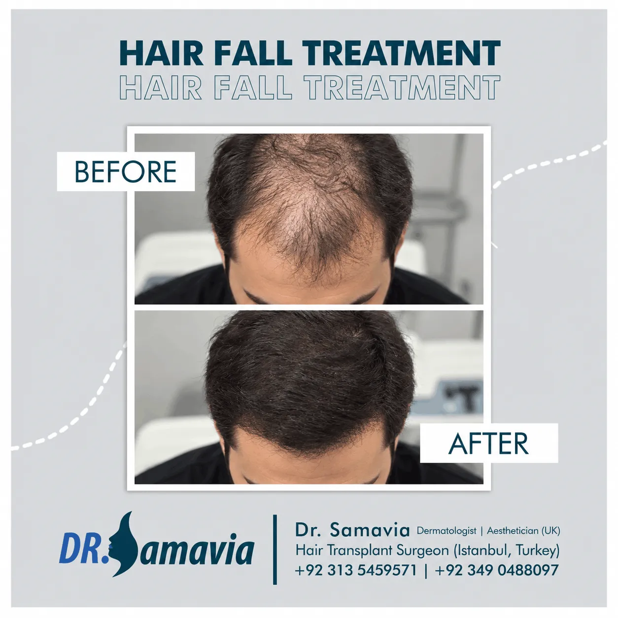 Hair Fall Treatment