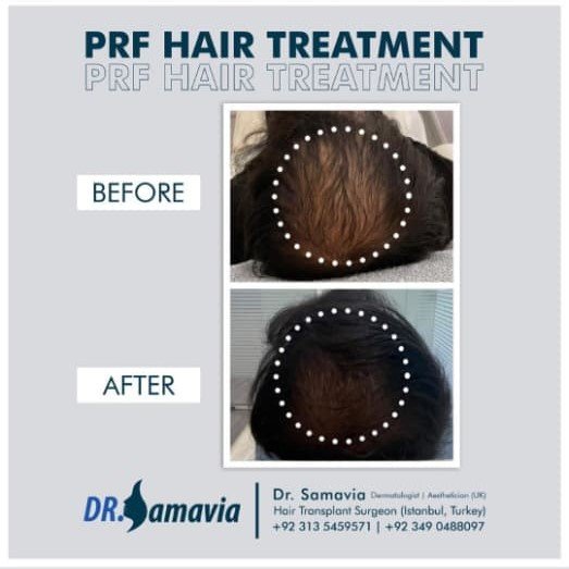 PRF Hair Treatment