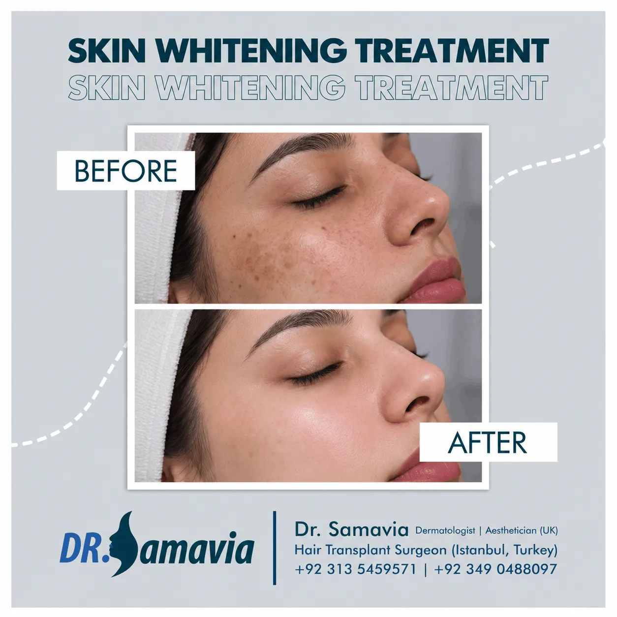 Skin Whitening Treatment