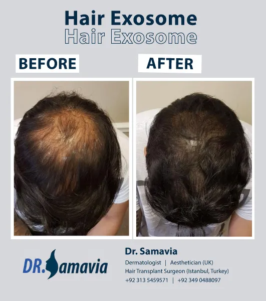 Hair Exosome Treatment