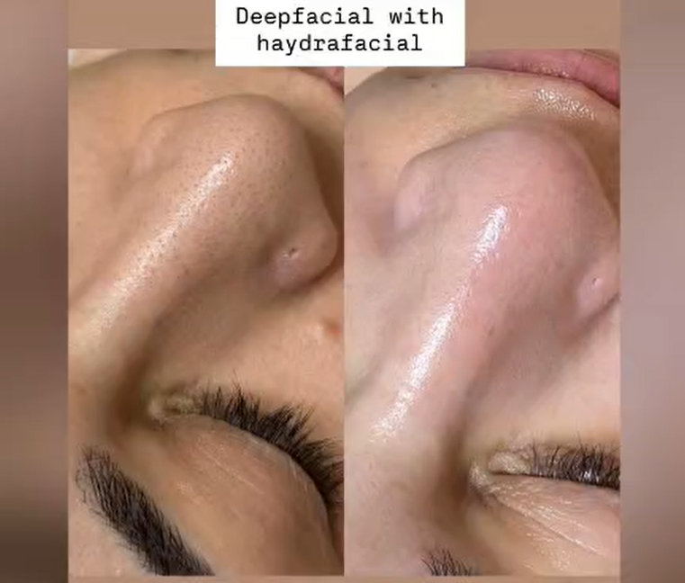 Hydrafacial Cost in Islamabad: What You Should Actually Pay