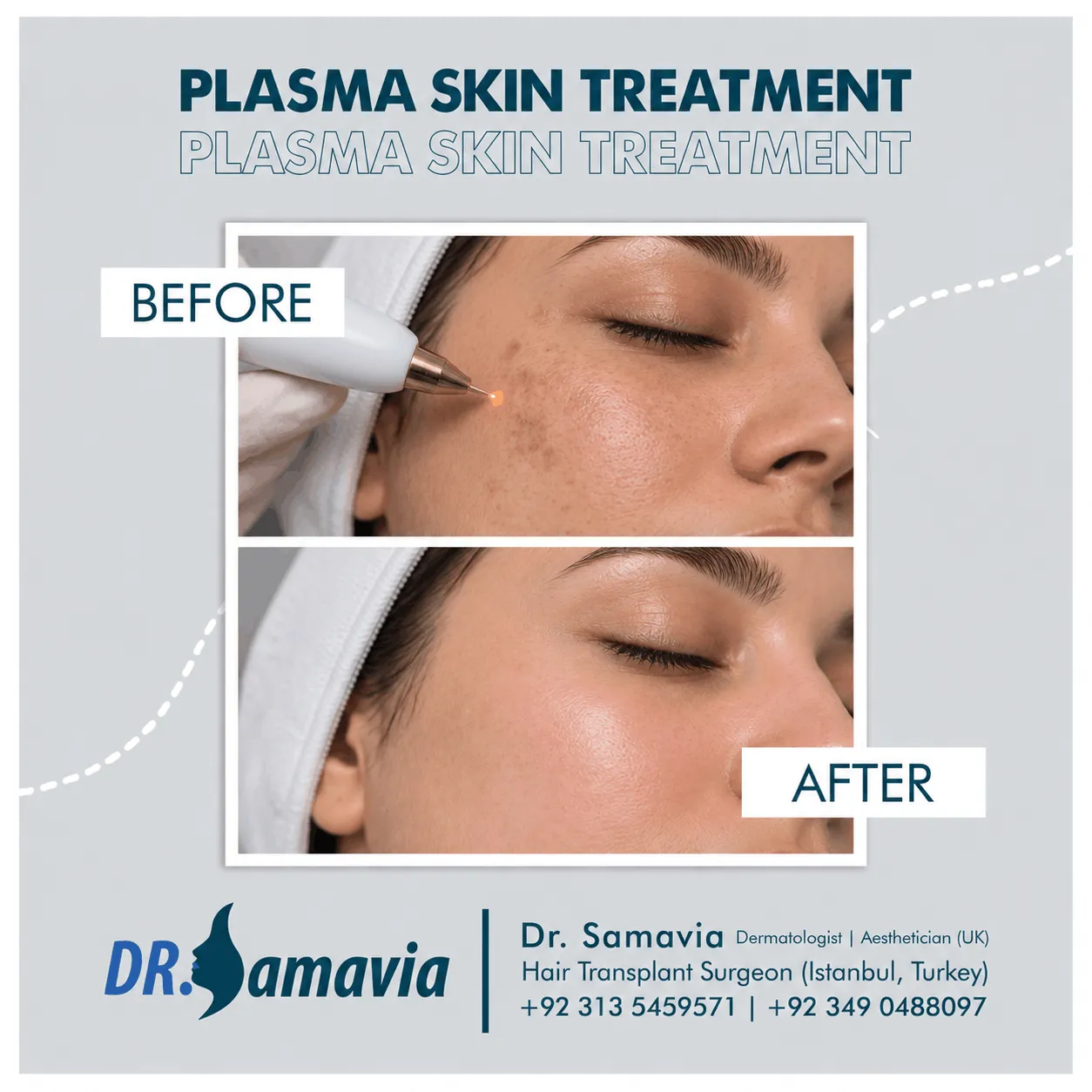 Plasma Skin Treatment