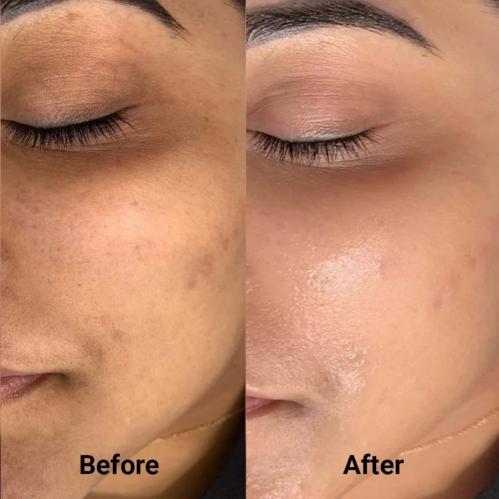 Chemical Peel