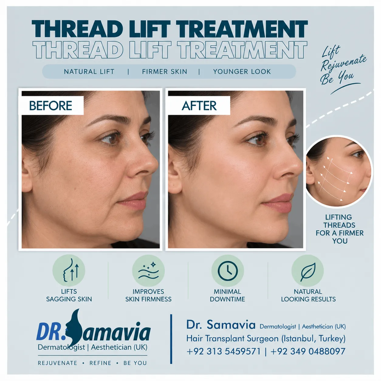 Thread Lift Treatment