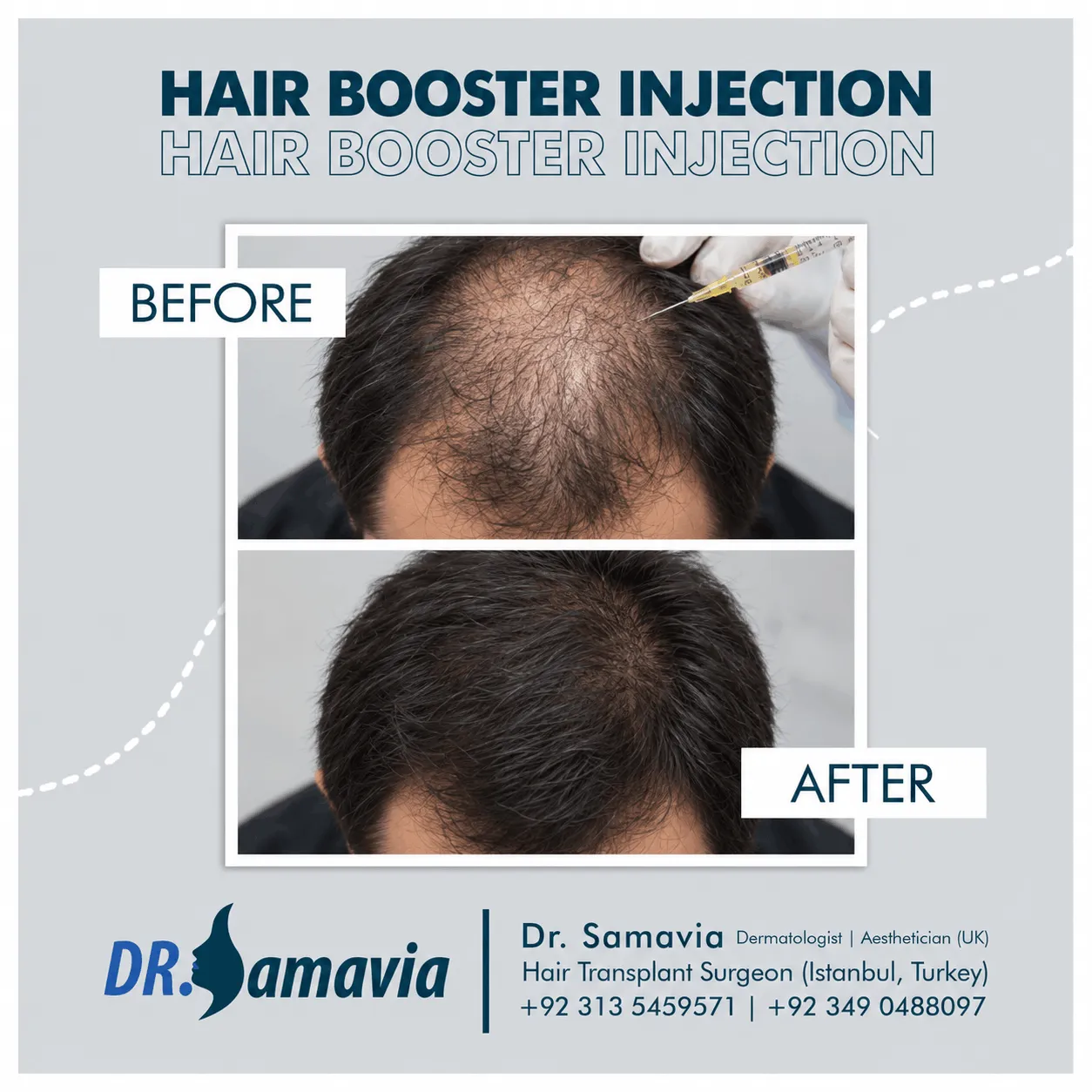 Hair Booster Injection