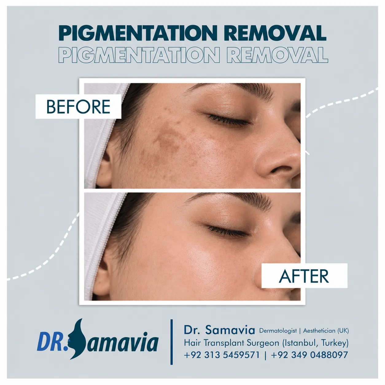 Pigmentation Removal