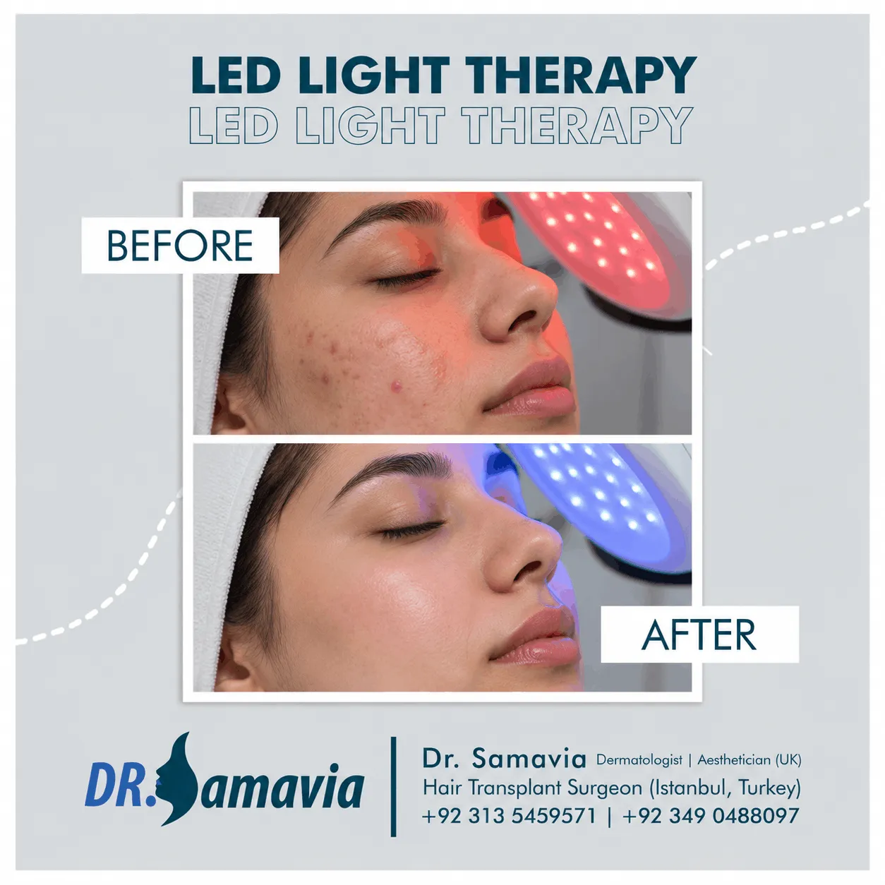 LED Light Therapy