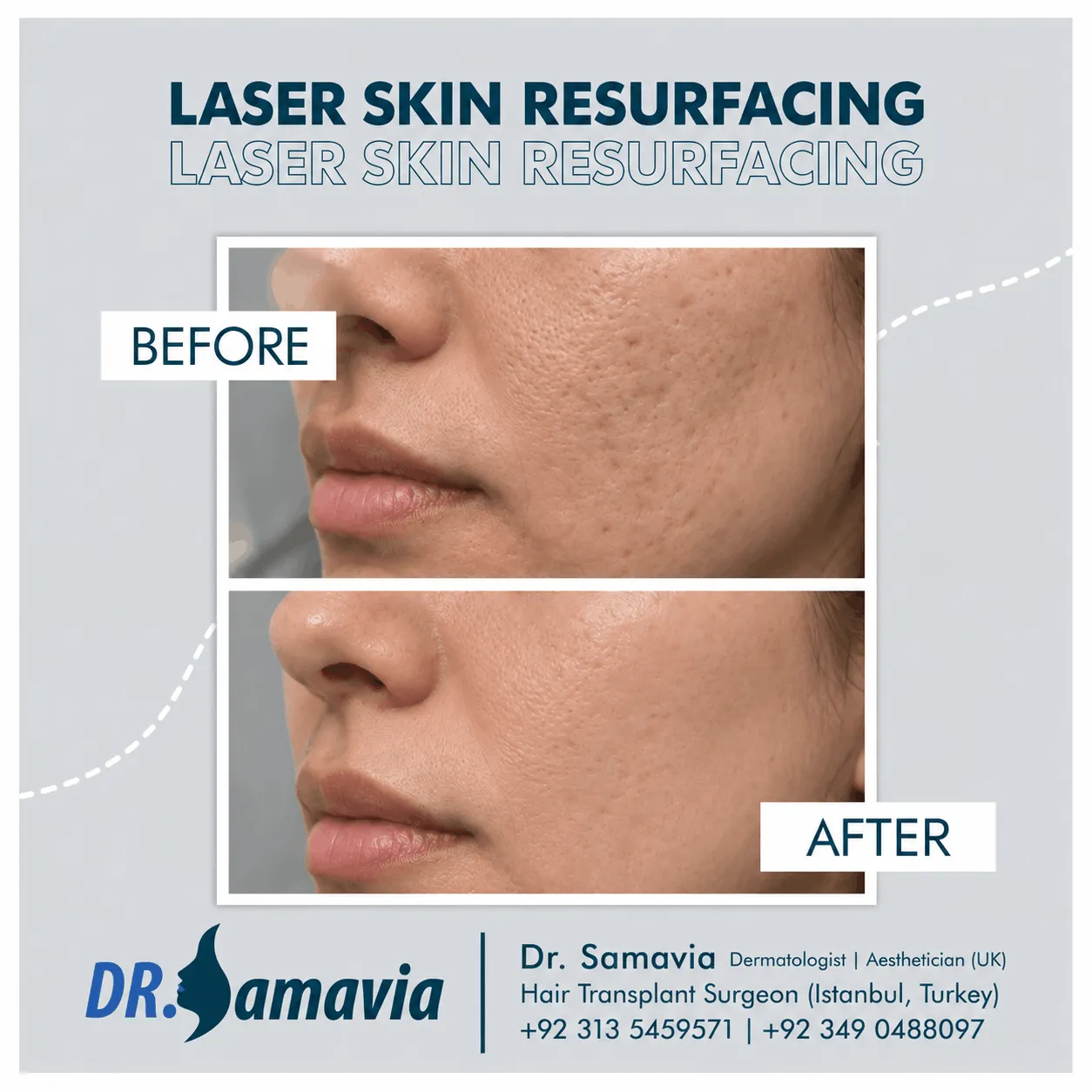 Laser Skin Resurfacing
