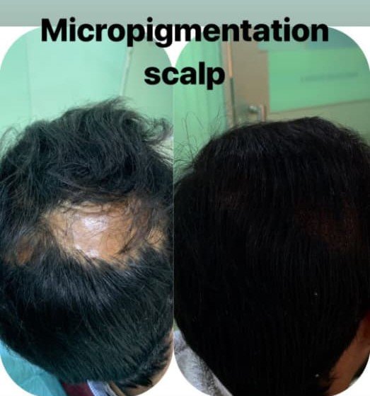 Scalp Micropigmentation