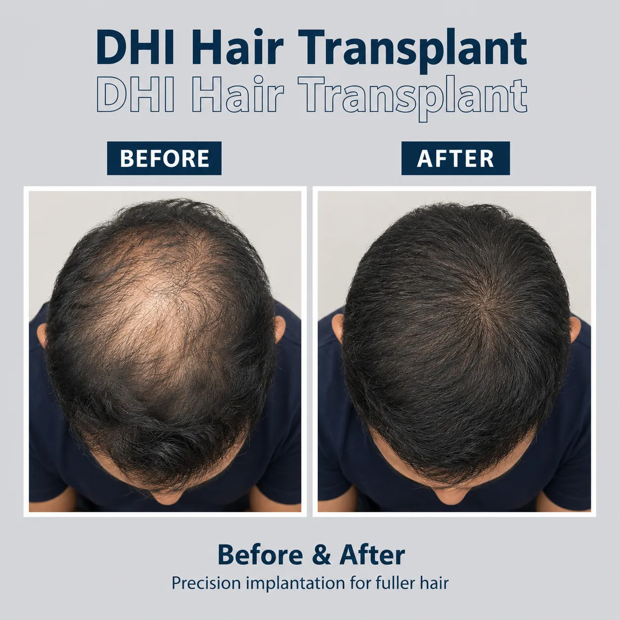 DHI Hair Transplant